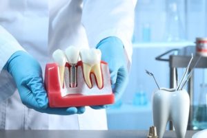 how do dental implants work procedure