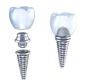 
one dental implants prices brisbane