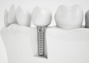 price teeth implant brisbane