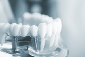 low cost teeth implants brisbane